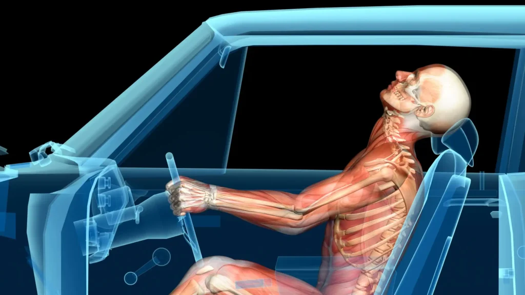 Whiplash After a Car Accident? Here’s What You Need to Know